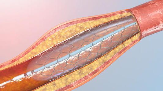 心脏支架价格是怎么降下来的 心脏支架降至700