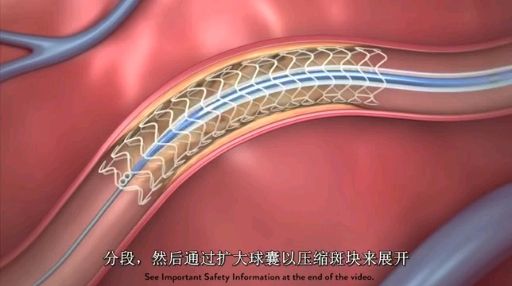 心脏支架价格是怎么降下来的 心脏支架从1.3万降至700元