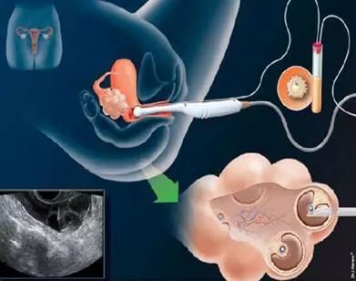 取卵黑手伸向女大学生 一次1至3万 人工取卵对身体的危害