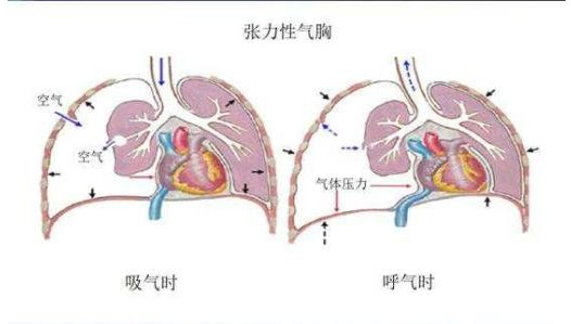 男子空中突发气胸险窒息 气胸是什么原因引起的