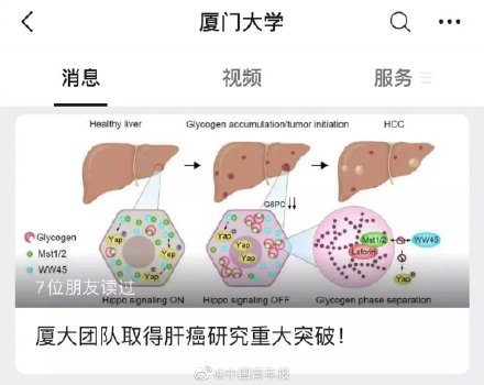 高校取得肝癌研究重大突破 有个消息让人痛心 厦大取得肝癌研究重大突破