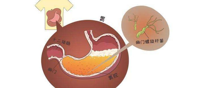 美国将幽门螺旋杆菌列为明确致癌物 幽门螺旋杆菌定植在人体胃部