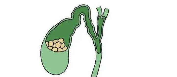 胆囊结石的早期症状 胆囊结石手术一定要摘除胆囊吗