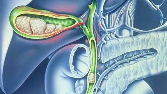 胆囊结石会变成胆囊癌吗 胆囊癌的早期症状