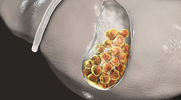 胆囊结石会变成胆囊癌吗 胆囊癌的早期症状