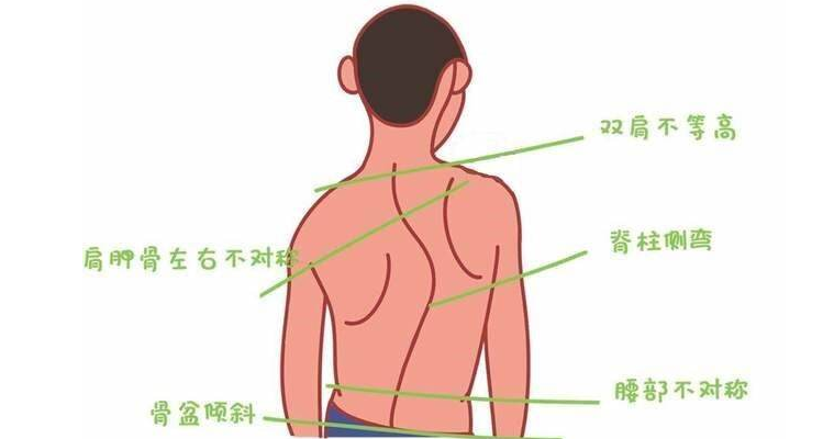 脊柱侧弯姿势矫正方法有哪些 有哪些方法可以矫正脊柱侧弯