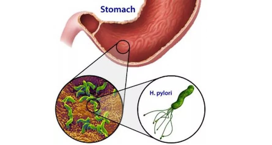 超6成家庭感染幽门螺杆菌 儿童更易感染幽门螺杆菌 幽门螺杆菌有哪些症状