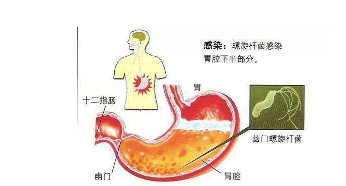 日常生活中如何避免幽门螺杆菌感染 幽门螺旋杆菌检查注意事项