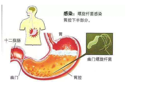 感染幽门螺杆菌到胃癌需要几步 幽门螺杆菌到胃癌一共有多少步