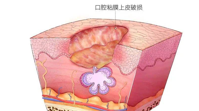 口腔溃疡会有哪些症状 哪些症状是口腔溃疡的表现