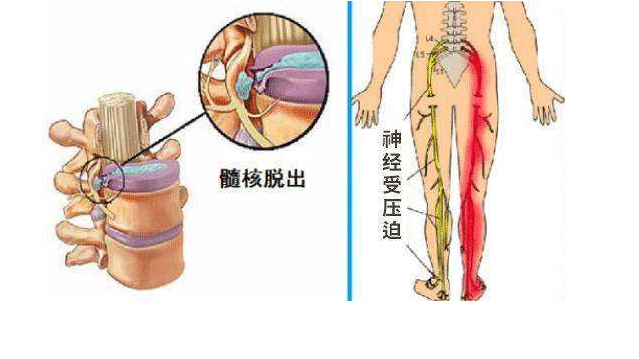 腰间盘突出严重会导致瘫痪吗 腰间盘突出最严重会有什么后果