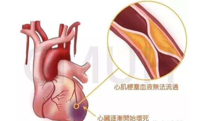 为什么年轻心梗患者九成是男性 年轻心梗患者九成是男性的原因是什么