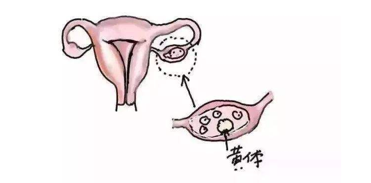 憋尿会不会导致黄体破裂 憋尿黄体破裂是怎么回事